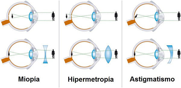 miopia hipermetropia astigmatismo presbicia)